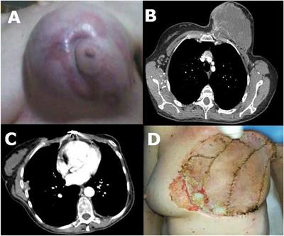 Case Report: Surgical Reconstruction of a Massive Thoracic Wall Defect After the Resection of an Undifferentiated Radiation-Induced Sarcoma of the Breast